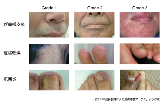 図2：Grade別の皮膚症状