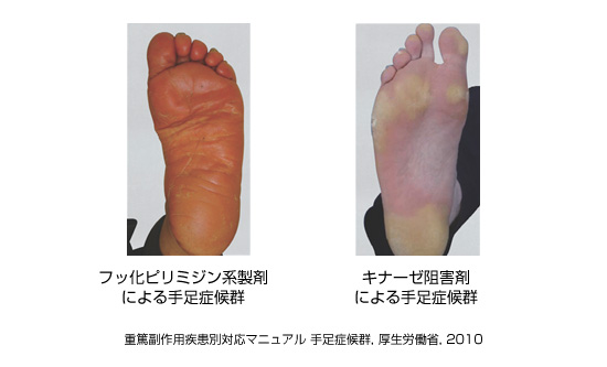 皮膚障害-2 手足症候群｜副作用対策講座｜消化器癌治療の広場 GI cancer-net