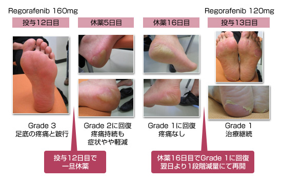 皮膚障害 2 手足症候群 副作用対策講座 消化器癌治療の広場 Gi Cancer Net