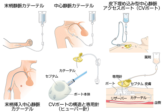 カテーテル関連血流感染 副作用対策講座 消化器癌治療の広場 Gi Cancer Net